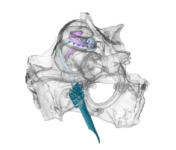 Optisches Cochlea Implantat in der Hörschnecke einer Wüstenrennmaus: Das Modell der spiralförmigen Hörschnecke einer Wüstenrennmaus (grau).Das Spiralganglion mit den Hörnervenzellen ist in violett, optisches Cochlea-Implantat ist in blau da rgestellt.